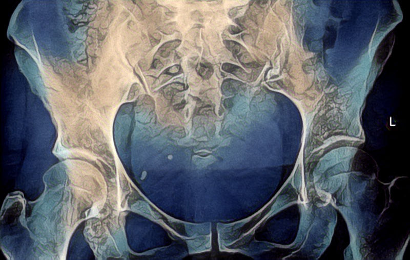 PREVENTION AND TREATMENT OF HIP FRACTURE FOR SENIORS-Everyday Medical
