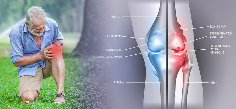 Osteoarthritis Knee Pain