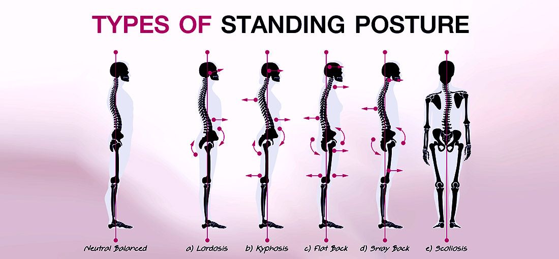 Posture Types