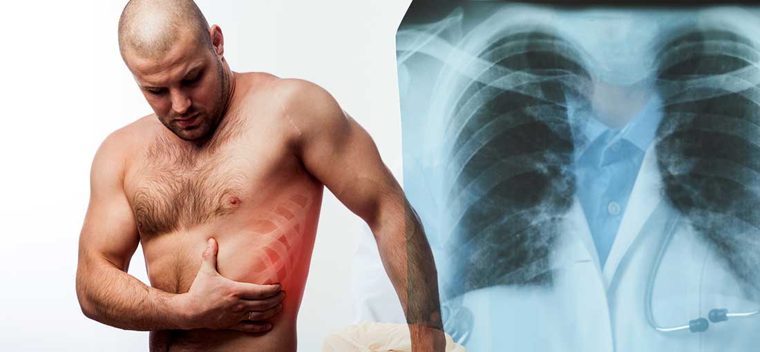 Person With Broken Rib Broken Rib Treatment: Do You Have Cracked Ribs? – Everyday Medical
