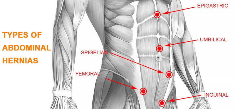 Abdominal Hernia