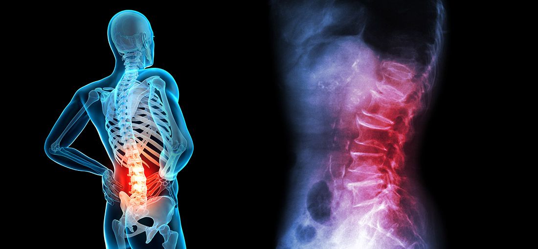 Lumbar Pain