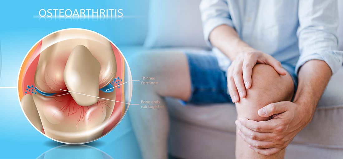 Knee Osteoarthritis